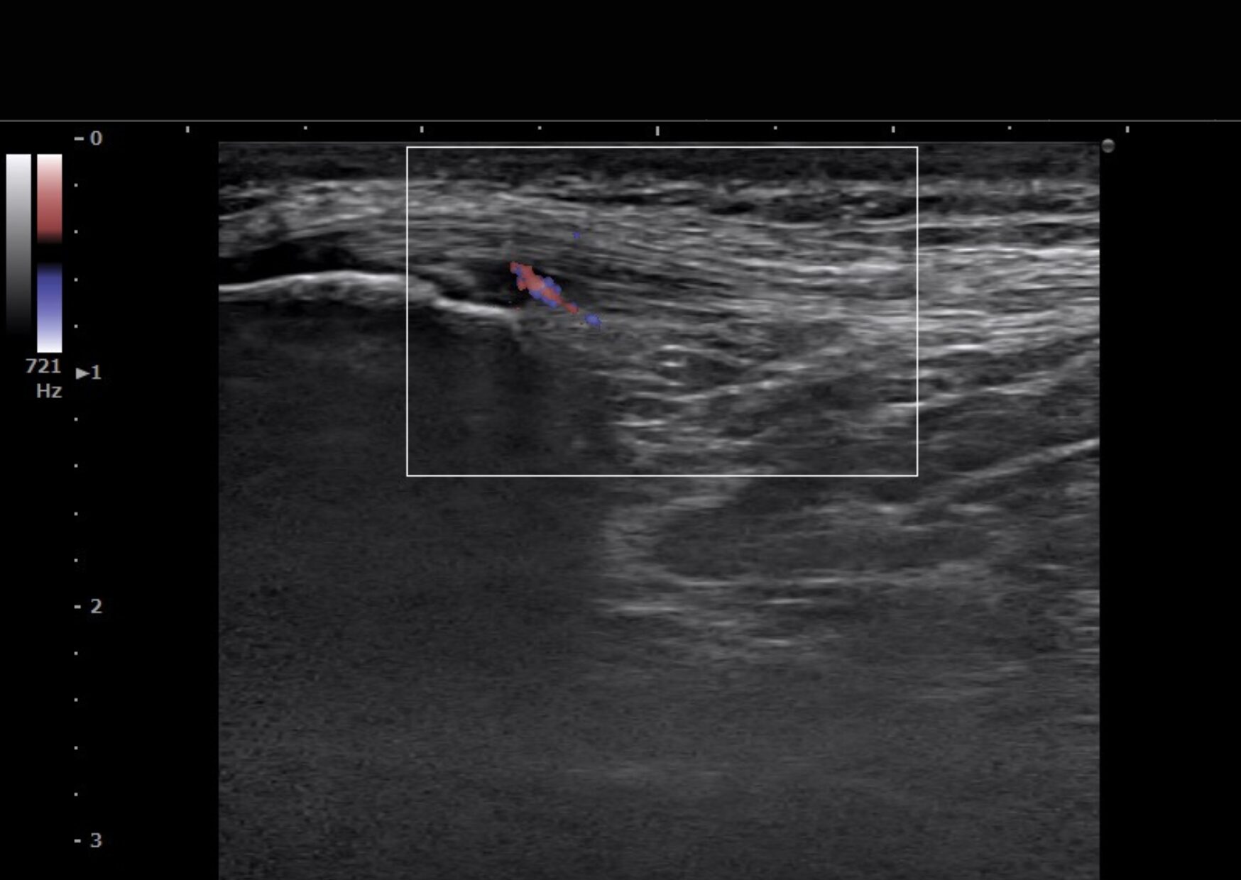 膝蓋靭帯炎のドップラーエコー画像