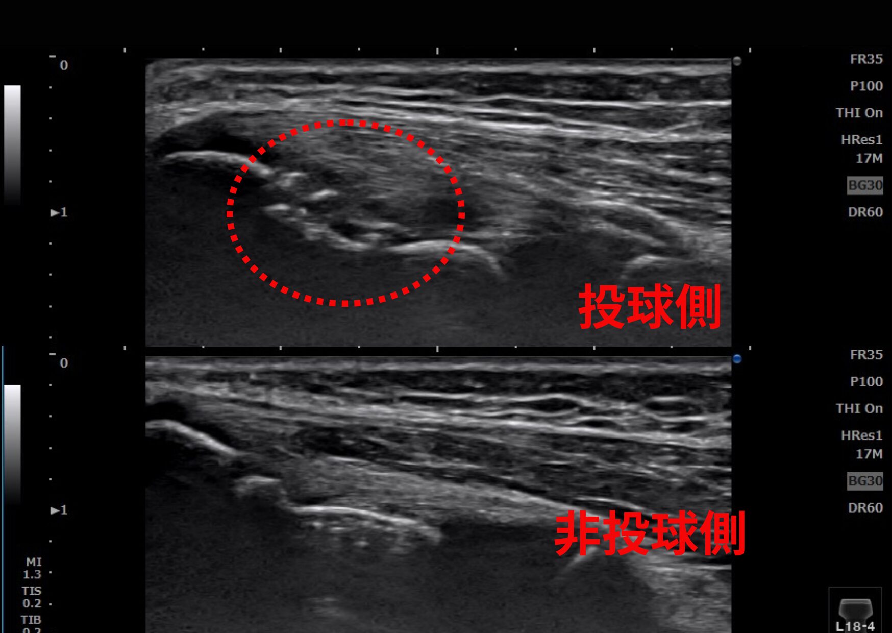 野球肘・内側上顆骨折のエコー画像